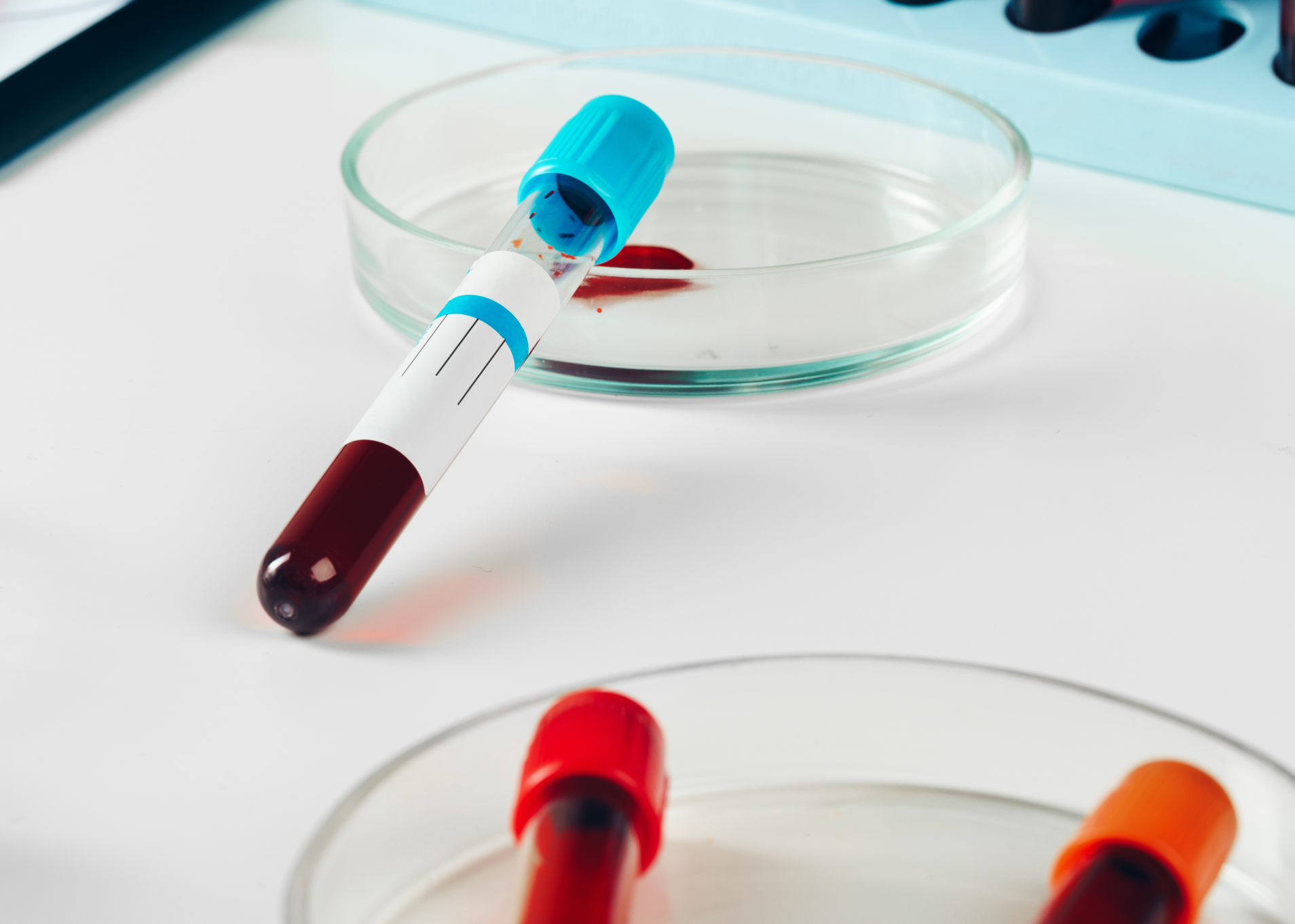 Sickle Cells Disease – Symptoms for adult &amp; pediatrics 