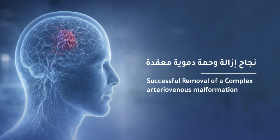 Successful Removal of a Complex Arteriovenous Malformation at Mouwasat Hospital in Madinah