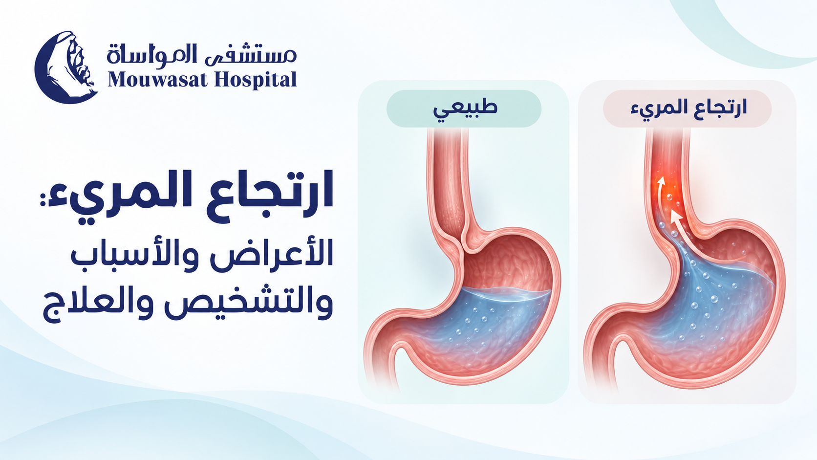GERD: Symptoms, Causes, Diagnosis &amp; Treatment