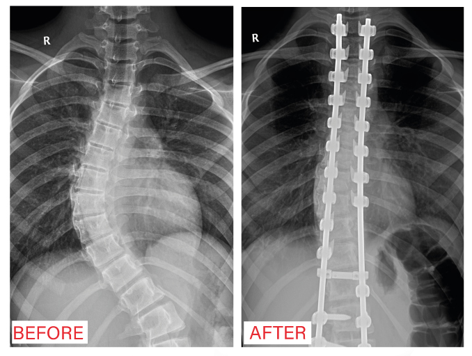 Rescuing a girl who was suffering from scoliosis in Al-Mouwasat Hospital in Riyadh