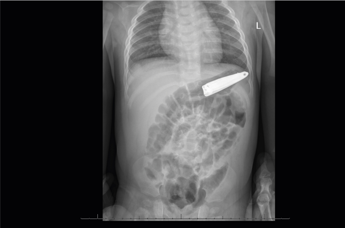 حالة نادرة الحدوث - إنقاذ حياة طفل يبلغ من العمر 7 شهور ابتلع قطعة حديدية (مقص أظافر) في مستشفي المواساة بالدمام.