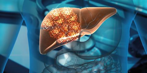 Mouwasat Hospital in Dammam successfully performs the first of its kind heating of malignant liver tumor using microwave ablation technique