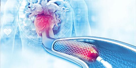 Implantation of a stent in the main coronary vein of the heart for a fifty years old female in Mouwasat Hospital Dammam