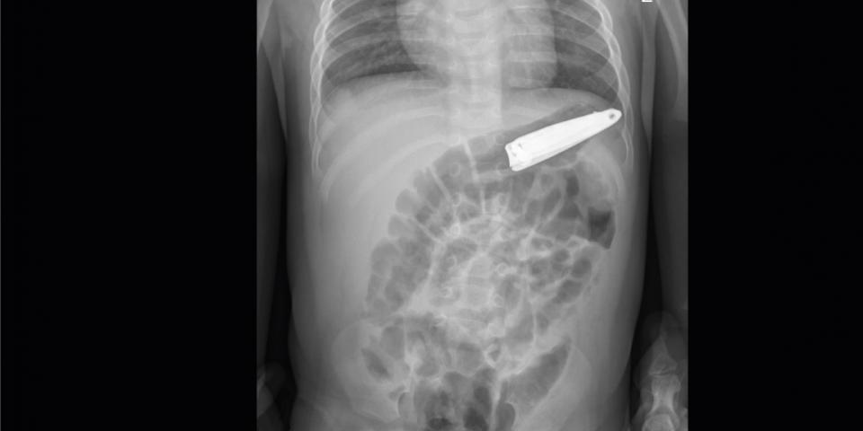 A Rare Case - Saving the life of a 7-month-old child who swallowed a piece of iron (nail clippers) at Al-Mouwasat Hospital in Dammam.
