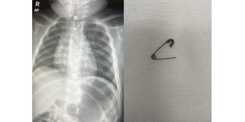After swallowing a pin... saving the life of a 10-month-old child at Al-Mouwasat Hospital in Dammam
