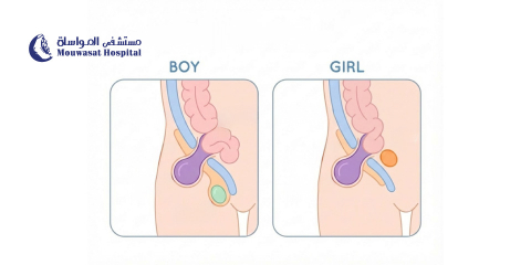 Inguinal Hernia in Children: Causes, Symptoms, and Treatment 