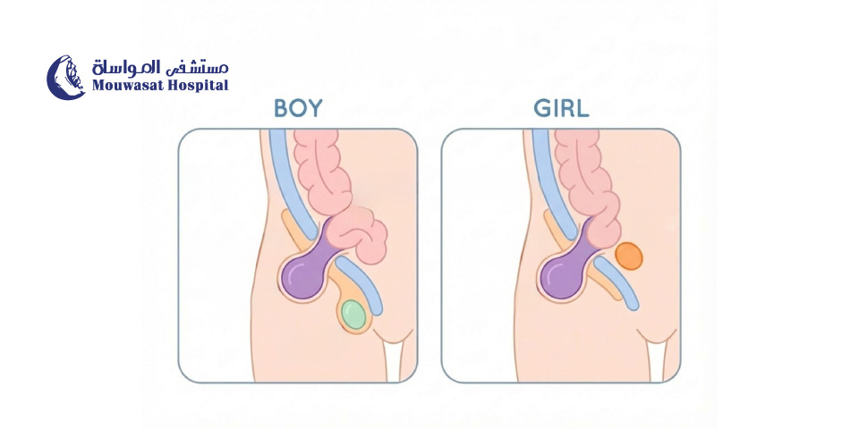 Inguinal Hernia in Children: Causes, Symptoms, and Treatment 